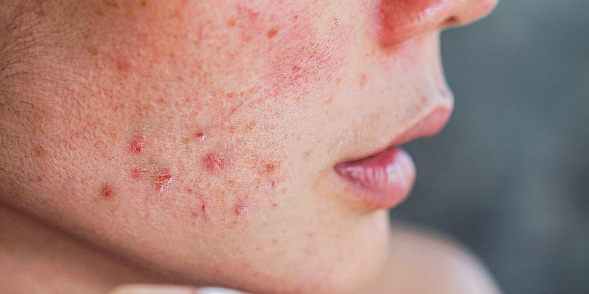 7 everyday habits that are destroying your skin barrier  stop NOW!
