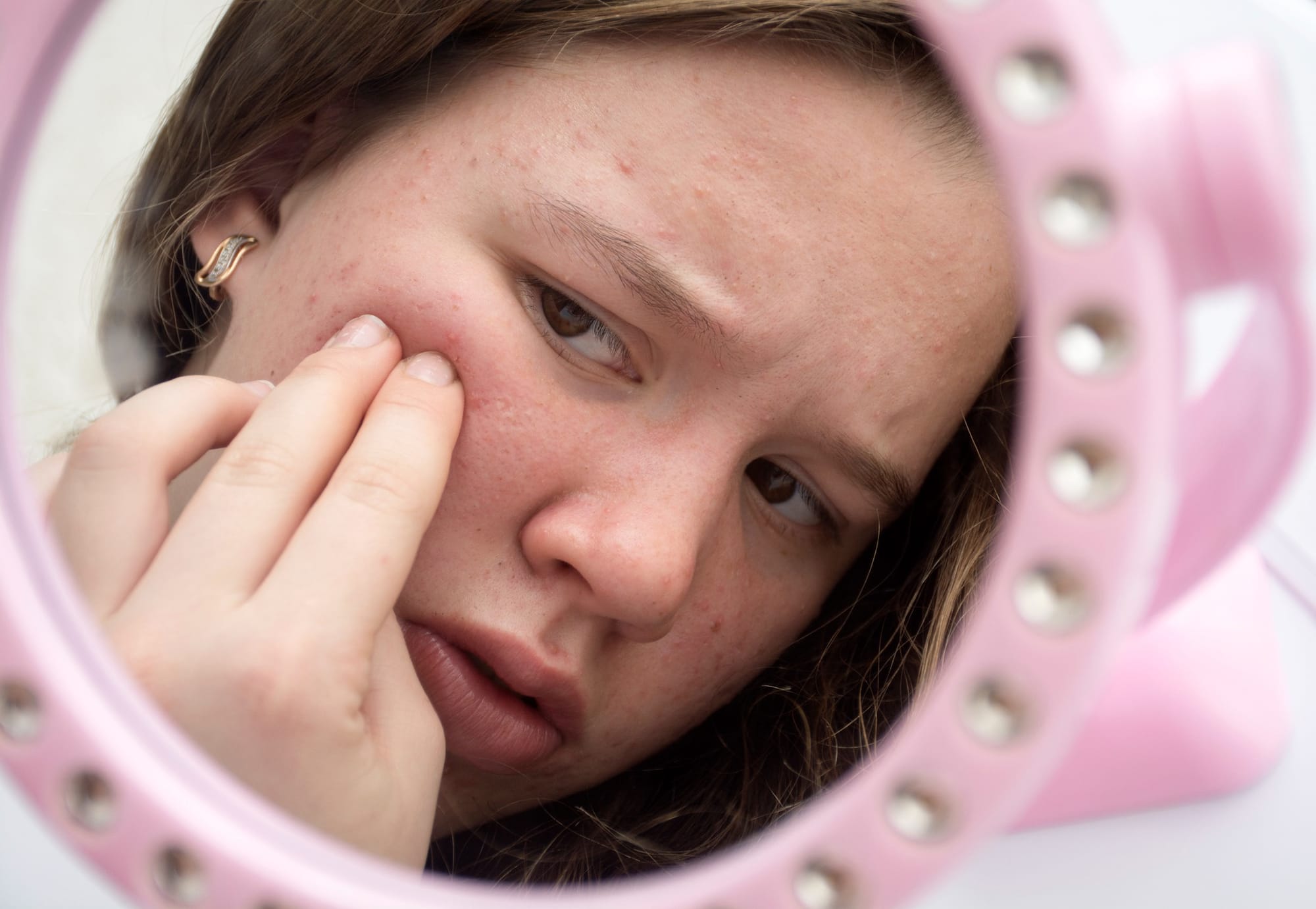 PCOS may soon get a new name and experts say it matters...