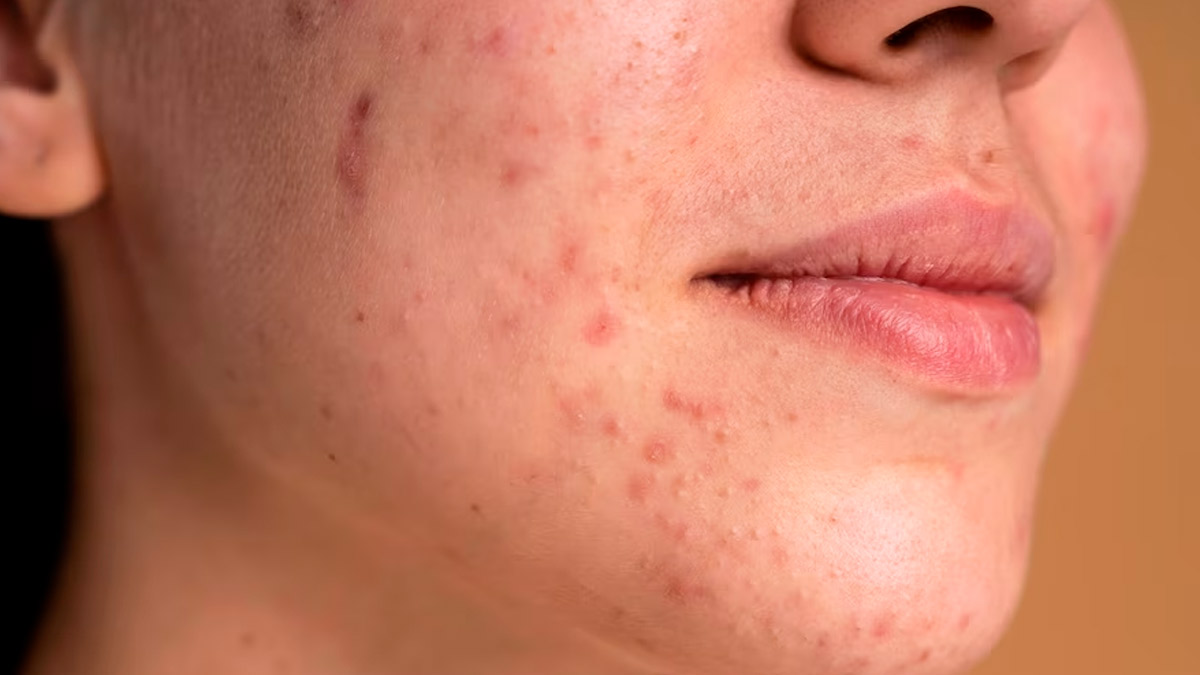Still breaking out on your chin? The reason isn’t what you think!