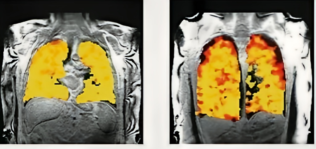Scientists develop scan that unravels secrets of lung functions!