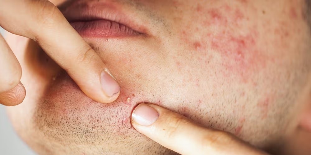 Why Men Experience Breakouts: Uncovering the Key Causes