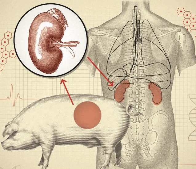 FDA Approves First-Ever Pig Kidney Transplant Trial for Humans