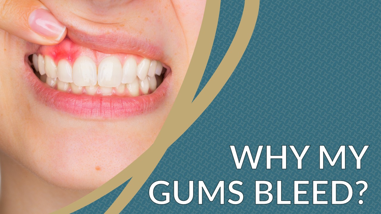Why Do Gums Bleed? Causes and Prevention