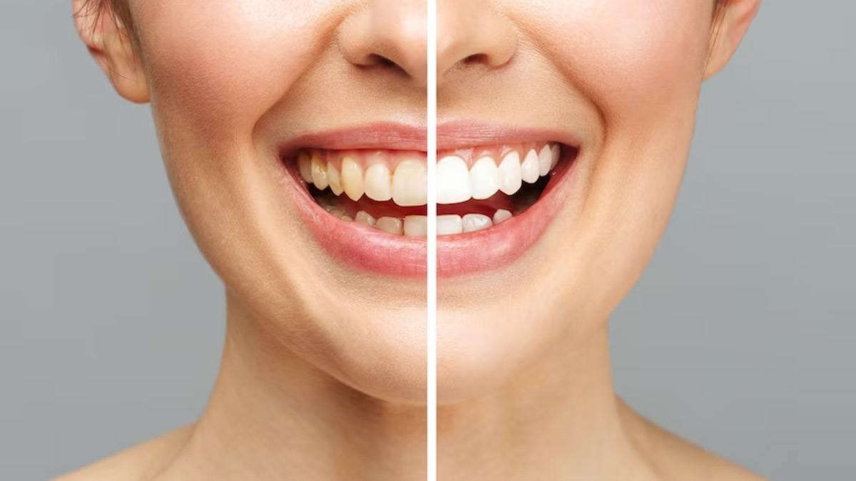 Can Salt & Mustard Oil Really Whiten Your Teeth?