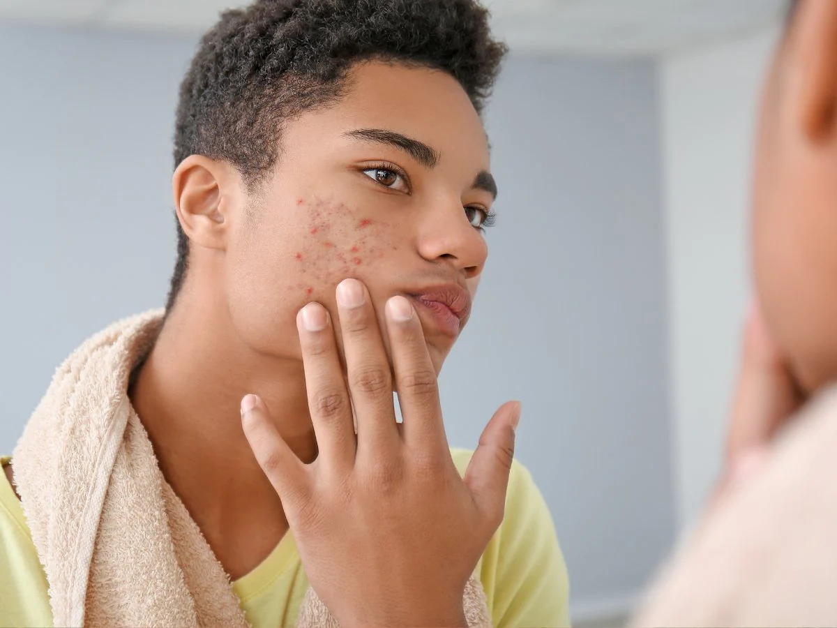 Acne isn’t personal—it’s puberty. But we got you teens!
