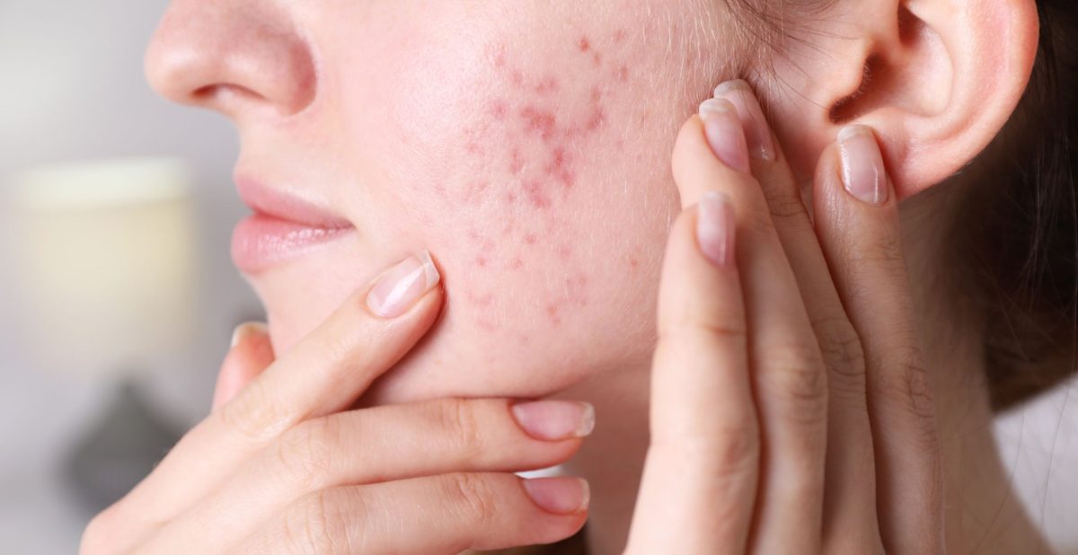 Still Breaking Out? Fix Hormonal Acne with This 7-Step Game-Changer