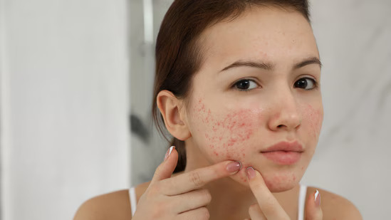Moved cities & now your skin's freaking out? Here's why