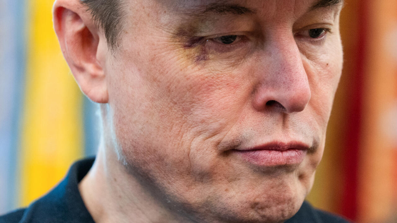 What’s that on Elon Musk’s face? The real story behind the bruise?